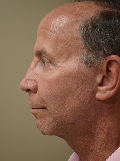 Facelift Before & After Gallery - Patient 324287 - Image 6