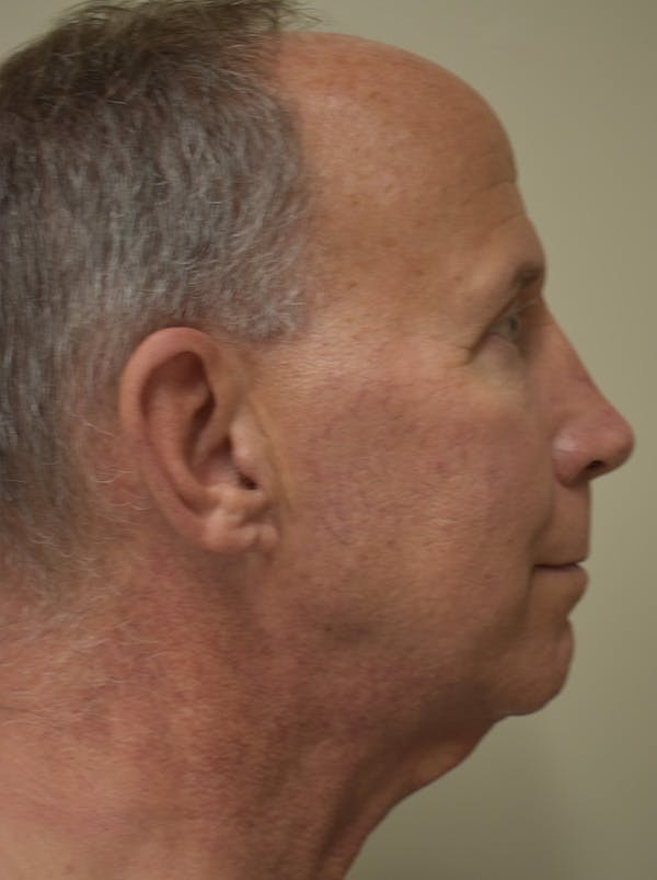 Facelift Before & After Gallery - Patient 324287 - Image 7
