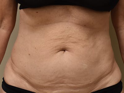 Tummy Tuck Before & After Gallery - Patient 259848 - Image 1