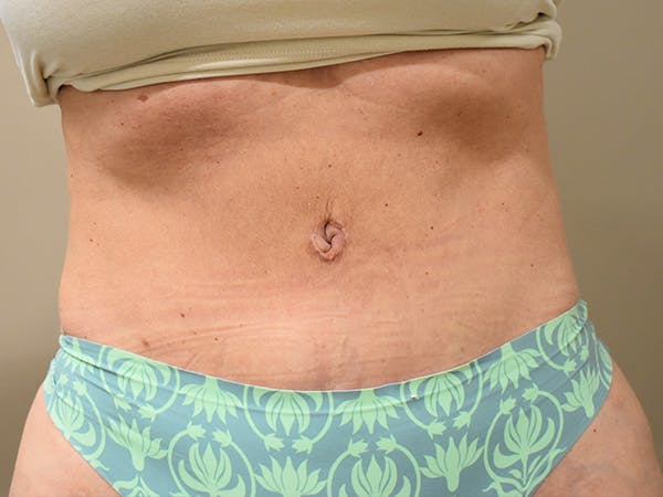 Tummy Tuck Before & After Gallery - Patient 259848 - Image 2