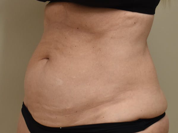 Tummy Tuck Before & After Gallery - Patient 259848 - Image 3