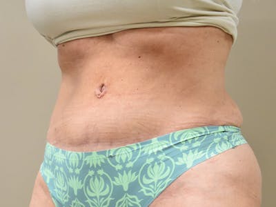 Tummy Tuck Before & After Gallery - Patient 259848 - Image 4
