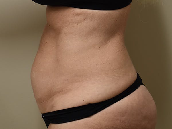 Tummy Tuck Before & After Gallery - Patient 259848 - Image 5