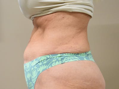 Tummy Tuck Before & After Gallery - Patient 259848 - Image 6