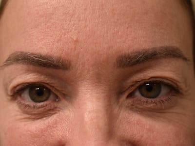 Eyelid Surgery Before & After Gallery - Patient 165698 - Image 1