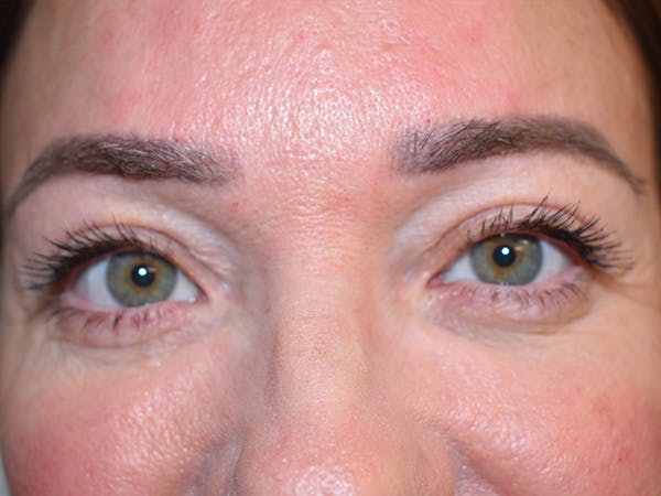 Eyelid Surgery Before & After Gallery - Patient 165698 - Image 2