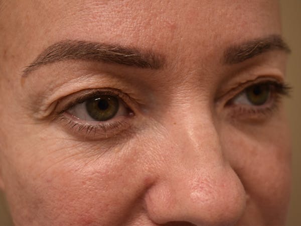 Eyelid Surgery Before & After Gallery - Patient 165698 - Image 4