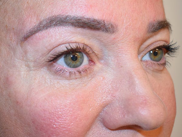 Eyelid Surgery Before & After Gallery - Patient 165698 - Image 3