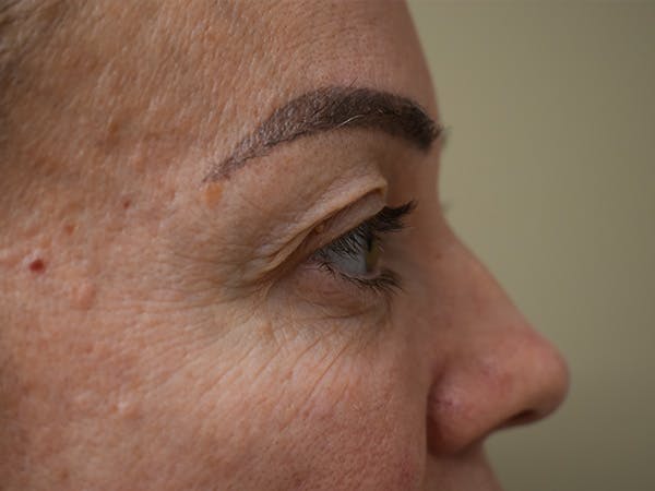 Eyelid Surgery Before & After Gallery - Patient 165698 - Image 5