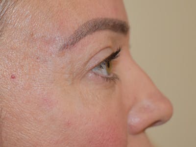 Eyelid Surgery Before & After Gallery - Patient 165698 - Image 6