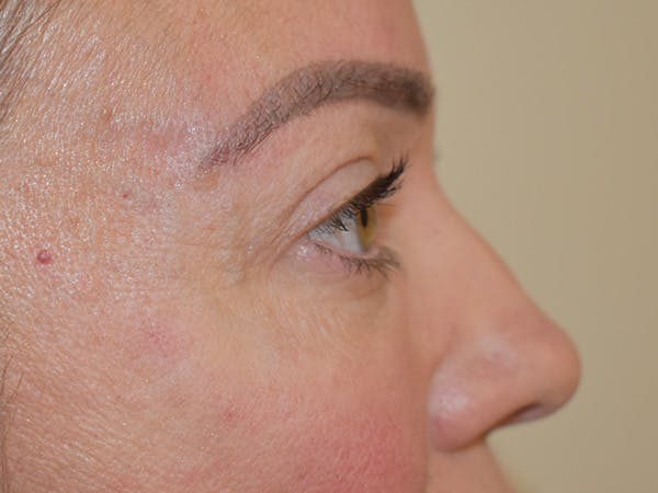 Eyelid Surgery Before & After Gallery - Patient 165698 - Image 6