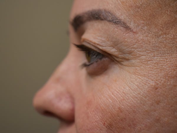Eyelid Surgery Before & After Gallery - Patient 165698 - Image 7