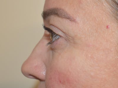 Eyelid Surgery Before & After Gallery - Patient 165698 - Image 8
