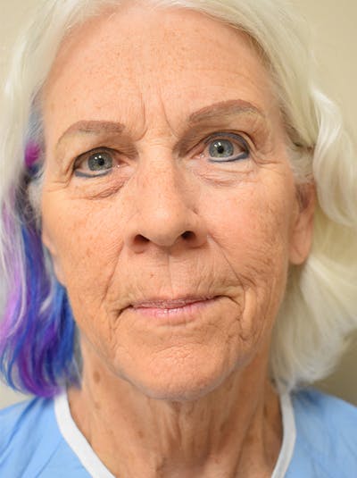 Eyelid Surgery Before & After Gallery - Patient 260035 - Image 1