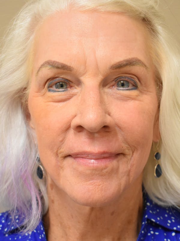 Facelift Before & After Gallery - Patient 378886 - Image 2