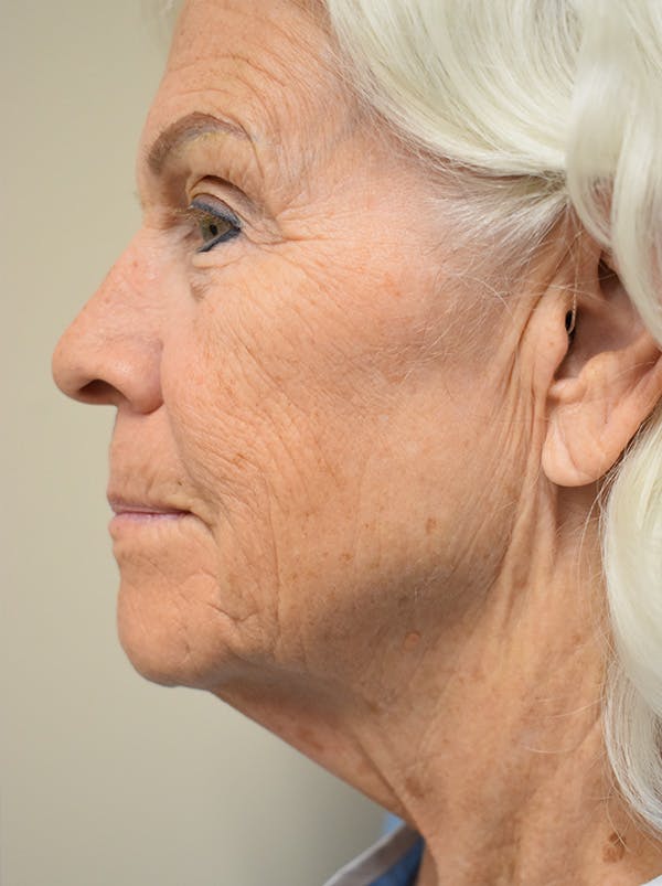 Facelift Before & After Gallery - Patient 378886 - Image 5