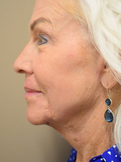 Facelift Before & After Gallery - Patient 378886 - Image 6