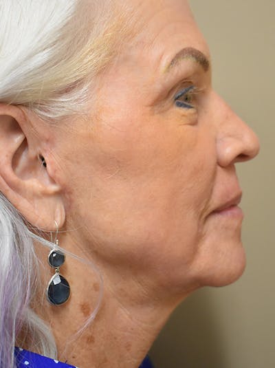 Facelift Before & After Gallery - Patient 378886 - Image 4