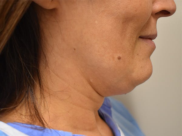 Chin Tuck Before & After Gallery - Patient 420788 - Image 1