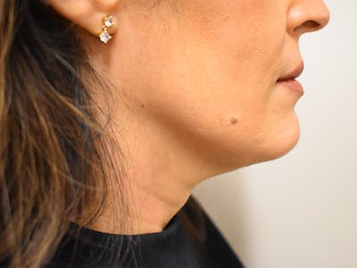 Chin Tuck Before & After Gallery - Patient 420788 - Image 2