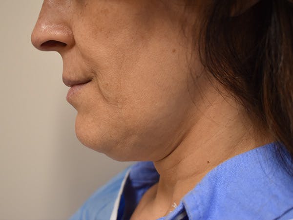 Chin Tuck Before & After Gallery - Patient 420788 - Image 3
