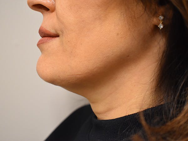 Chin Tuck Before & After Gallery - Patient 420788 - Image 4