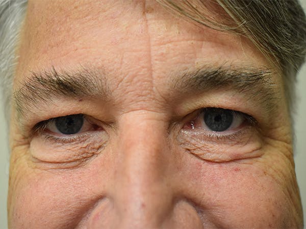 Eyelid Surgery Before & After Gallery - Patient 475469 - Image 1