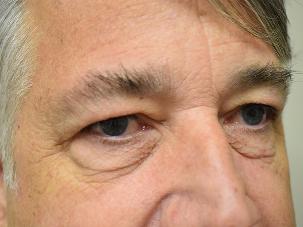 Eyelid Surgery Before & After Gallery - Patient 475469 - Image 3
