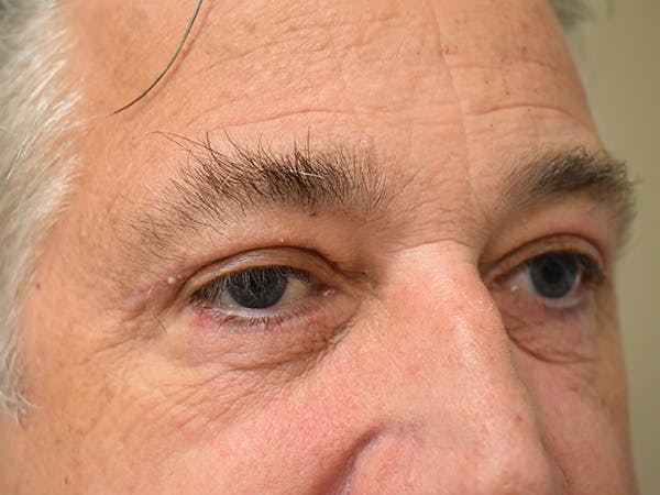 Eyelid Surgery Before & After Gallery - Patient 475469 - Image 4