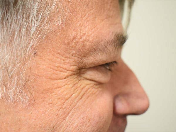 Eyelid Surgery Before & After Gallery - Patient 475469 - Image 5