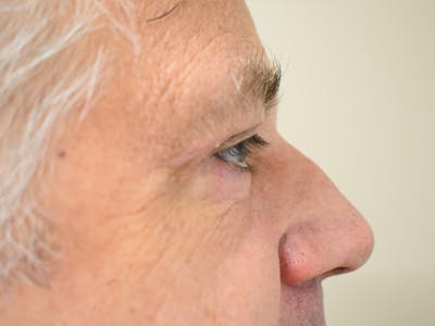 Eyelid Surgery Before & After Gallery - Patient 475469 - Image 6
