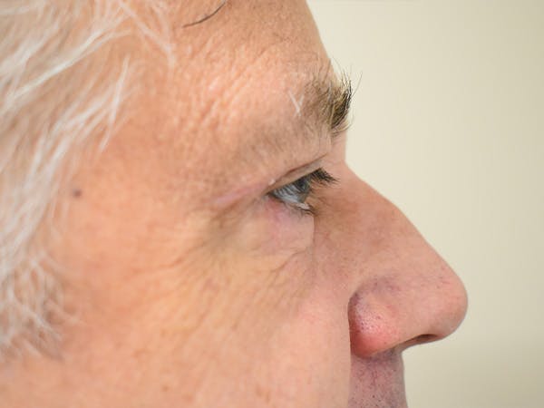 Eyelid Surgery Before & After Gallery - Patient 475469 - Image 6