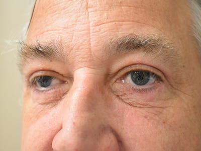 Eyelid Surgery Before & After Gallery - Patient 475469 - Image 8