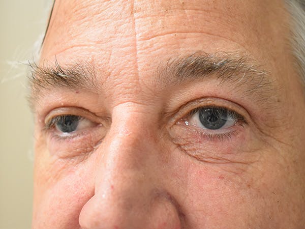 Eyelid Surgery Before & After Gallery - Patient 475469 - Image 8