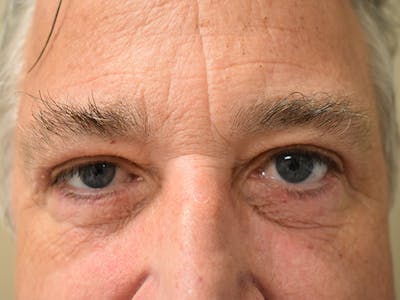 Eyelid Surgery Before & After Gallery - Patient 475469 - Image 2