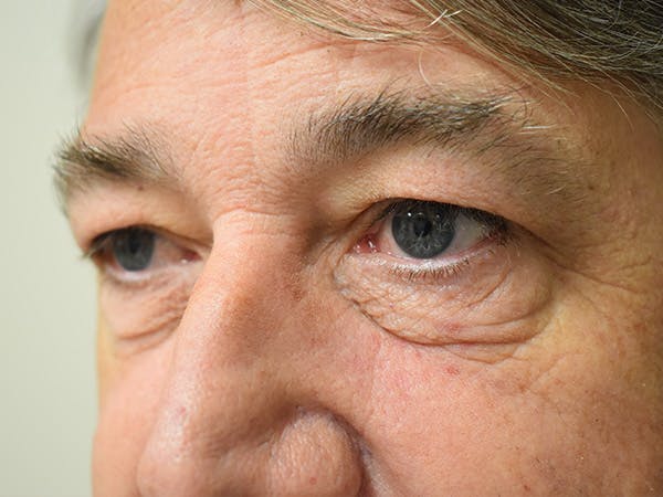 Eyelid Surgery Before & After Gallery - Patient 475469 - Image 7
