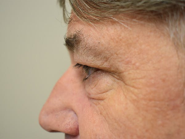 Eyelid Surgery Before & After Gallery - Patient 475469 - Image 9