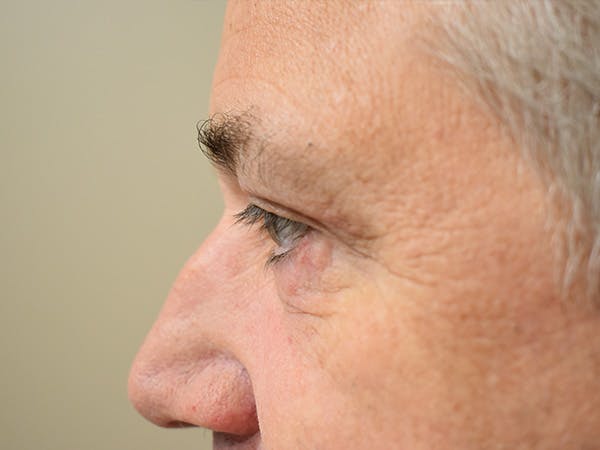 Eyelid Surgery Before & After Gallery - Patient 475469 - Image 10