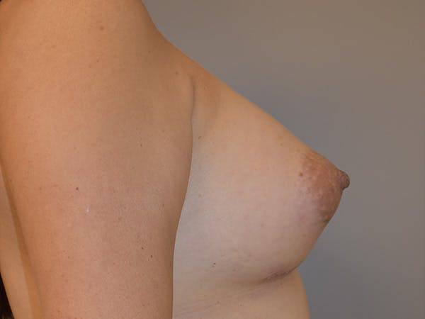 Breast Augmentation Before & After Gallery - Patient 295955 - Image 6