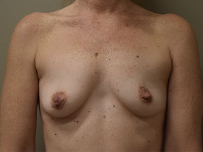 Breast Augmentation Before & After Gallery - Patient 210118 - Image 1