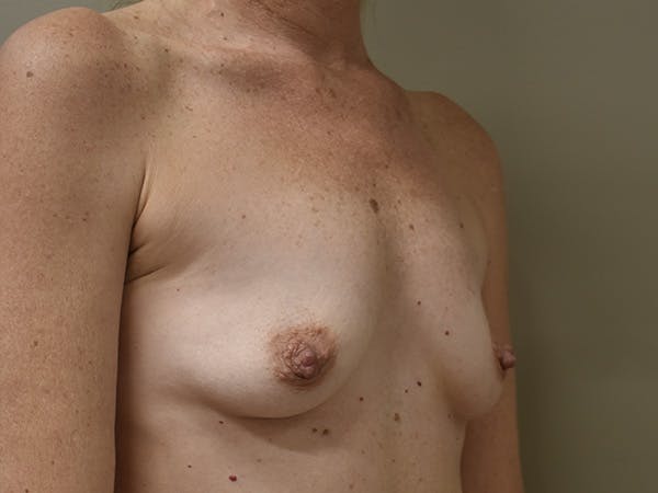 Breast Augmentation Before & After Gallery - Patient 210118 - Image 3
