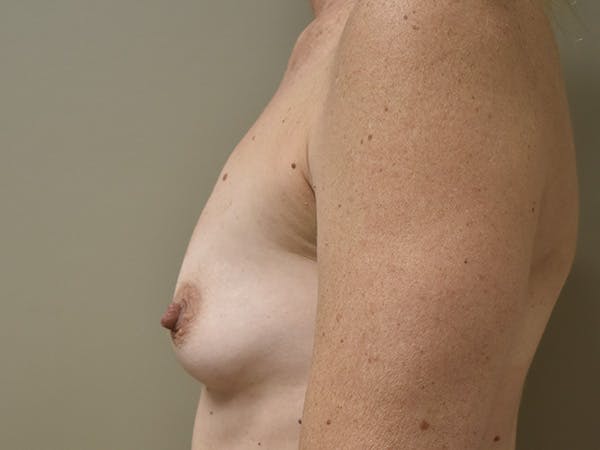 Breast Augmentation Before & After Gallery - Patient 210118 - Image 9