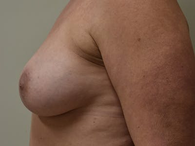 Breast Augmentation Before & After Gallery - Patient 403232 - Image 10