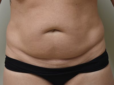 Tummy Tuck Before & After Gallery - Patient 378101 - Image 1