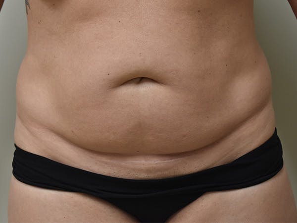 Tummy Tuck Before & After Gallery - Patient 378101 - Image 1