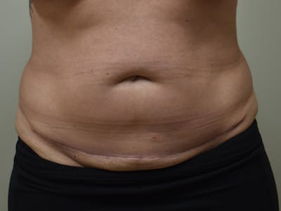 Tummy Tuck Before & After Gallery - Patient 378101 - Image 2