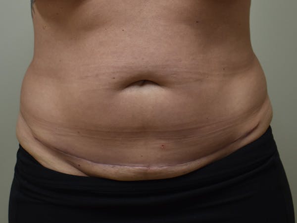 Tummy Tuck Before & After Gallery - Patient 378101 - Image 2