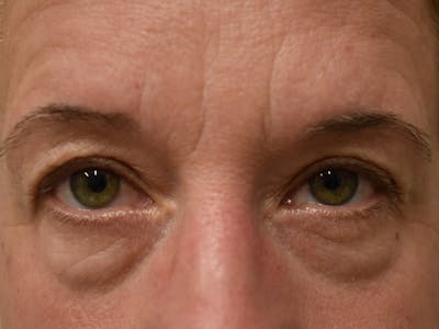 Eyelid Surgery Before & After Gallery - Patient 116341 - Image 1