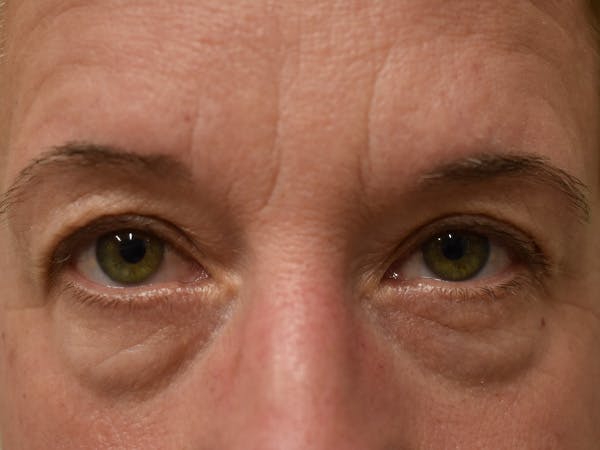 Eyelid Surgery Before & After Gallery - Patient 116341 - Image 1