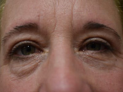 Eyelid Surgery Before & After Gallery - Patient 116341 - Image 2